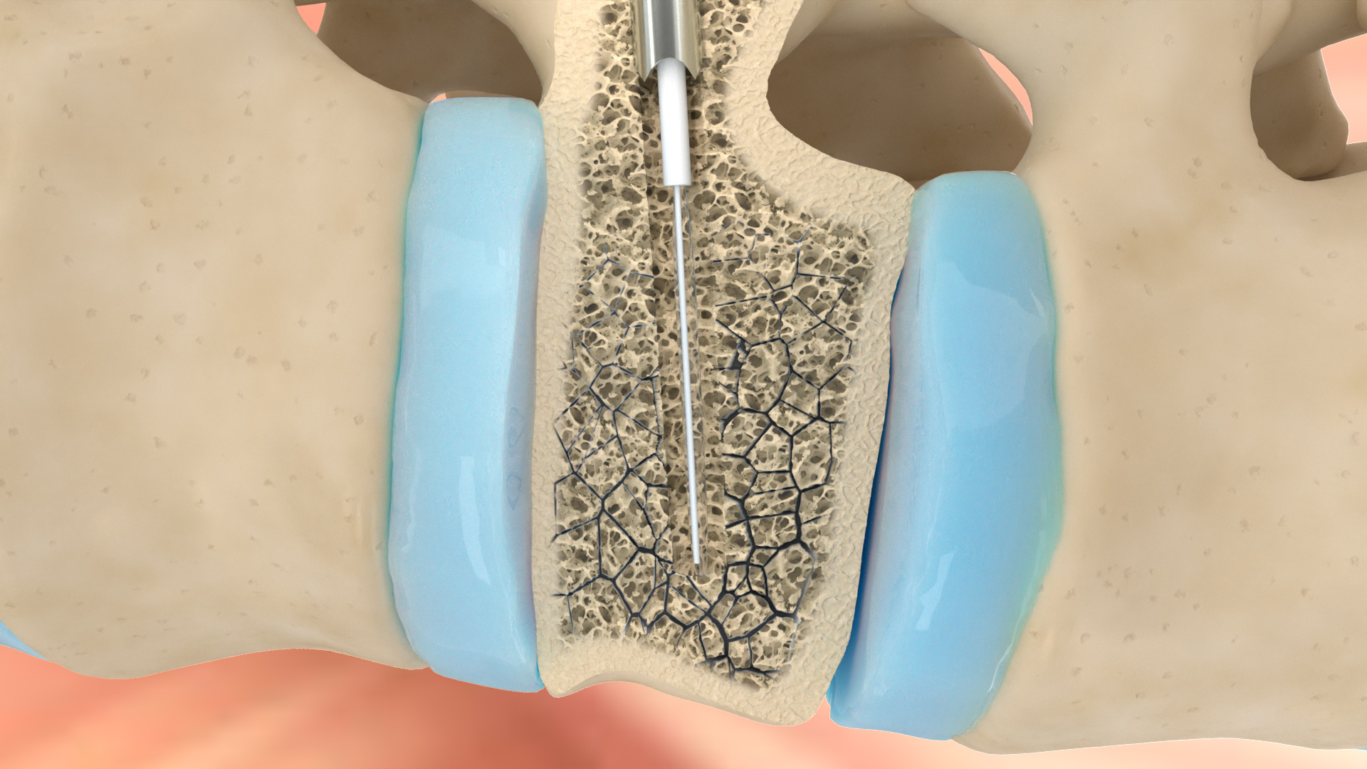 Video 3d tecnica chirurgica - Frattura vertebra - Emmebistudio.com